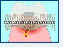 برس جرم گیر دندان رو و بین دندانی جدید اینتردنتال براش Interdental  Brush